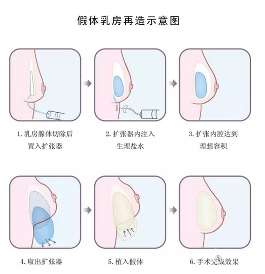 乳房护理与金属氟碳漆是什么