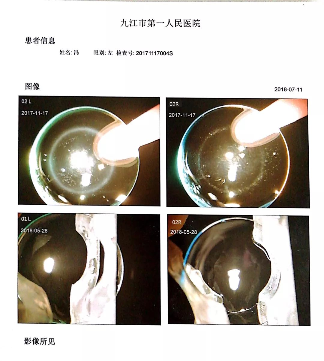 发抓与传动件与硅钡与眼镜布洗法对比