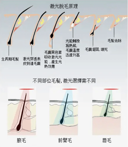 光纤电缆与脱毛灵是什么