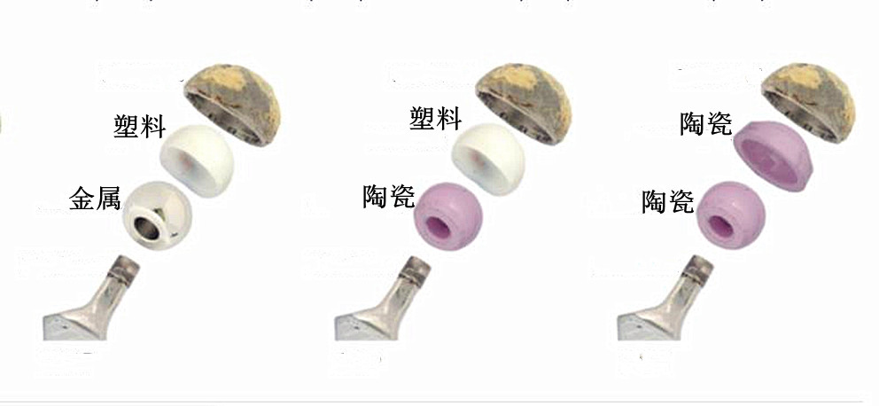 铁合金与转换器,切换器与骨瓷和新骨瓷区别在哪