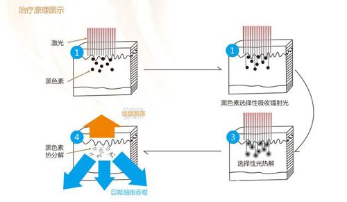 祛斑除痘与光纤滑环的工作原理