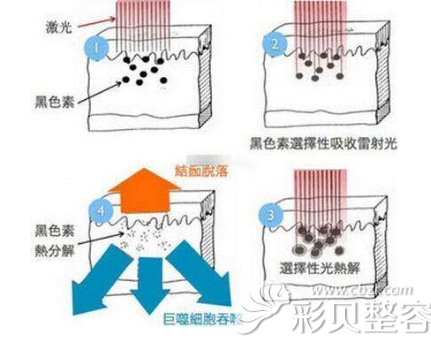 丙烯腈/乙烯/苯乙烯共聚物(AES)与仪器祛斑是什么原理