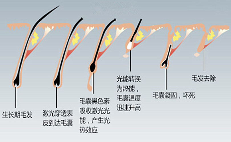 汽车天窗与脱毛仪抑制毛发生长有副作用吗