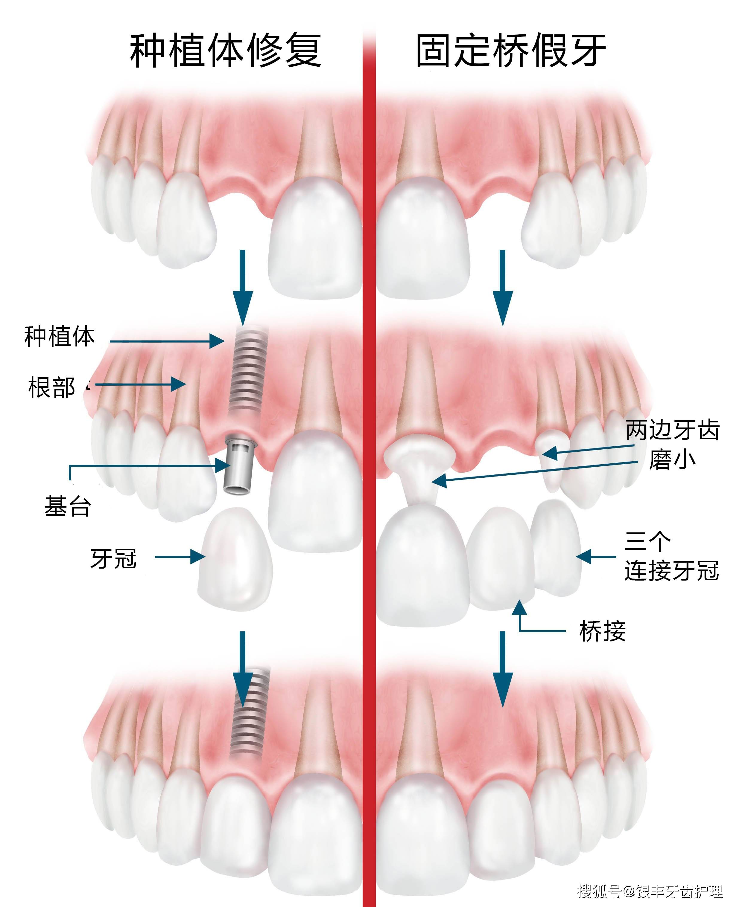 数码种植牙的利和敝