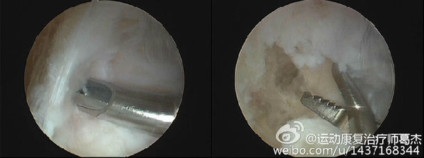 前叉术后关节粘连什么表现